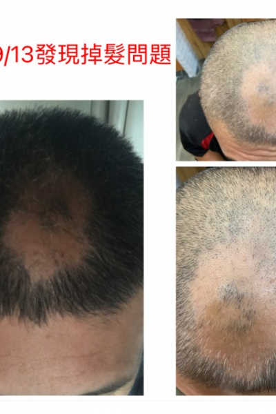 斷髮蘚菌造成掉髮調理約六個月（不分男女都有可能）